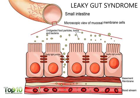 what causes increased intestinal permeability